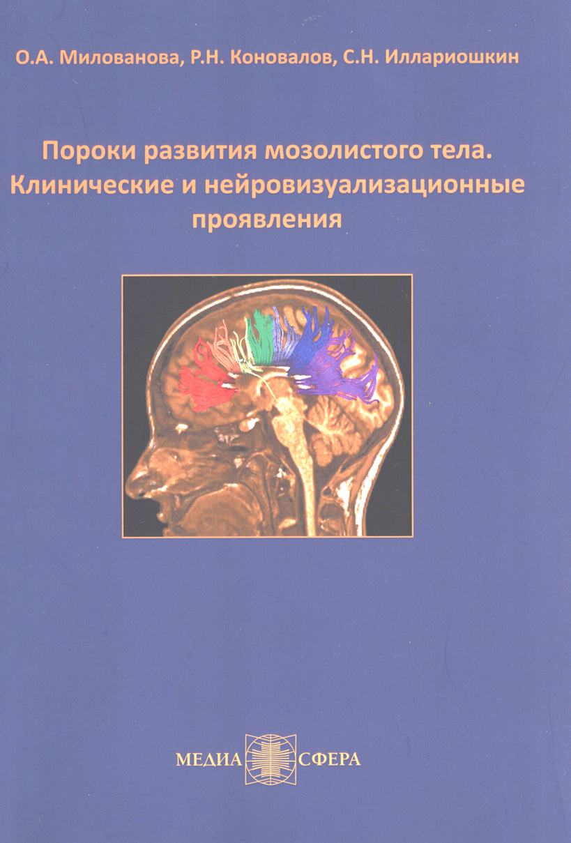 Пороки развития мозолистого тела. Клинические и нейровизуализационные проявления